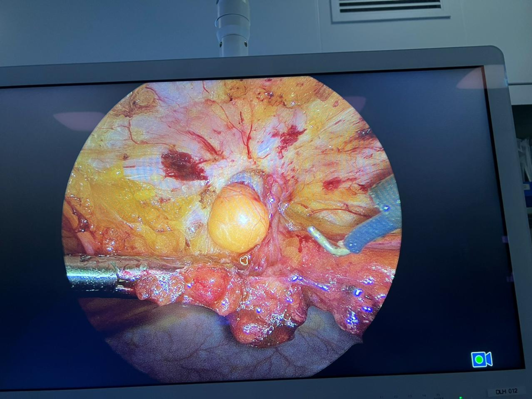 Laparoscopic umbilical hernia repair